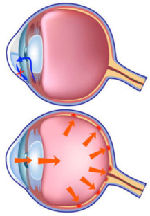 glaucoma glaucoma