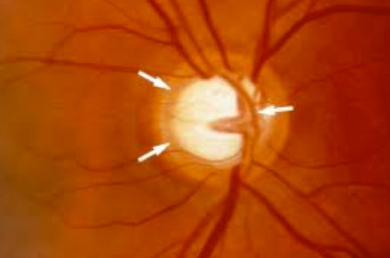 glaucoma3 glaucoma3