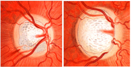 glaucoma4 glaucoma4