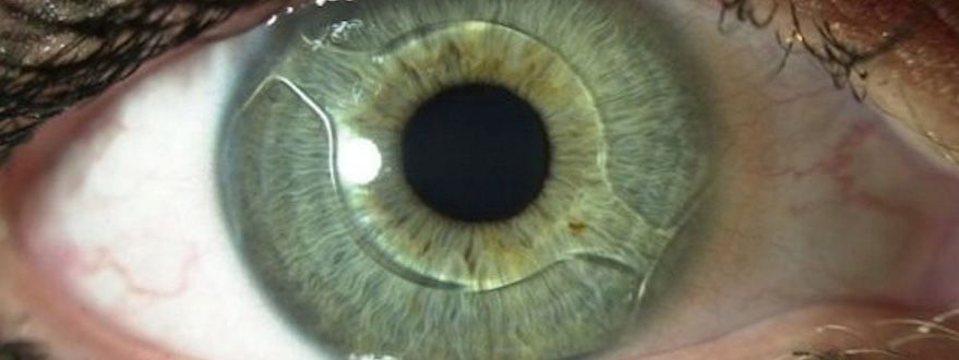 Lenti intraoculari deals per maculopatia